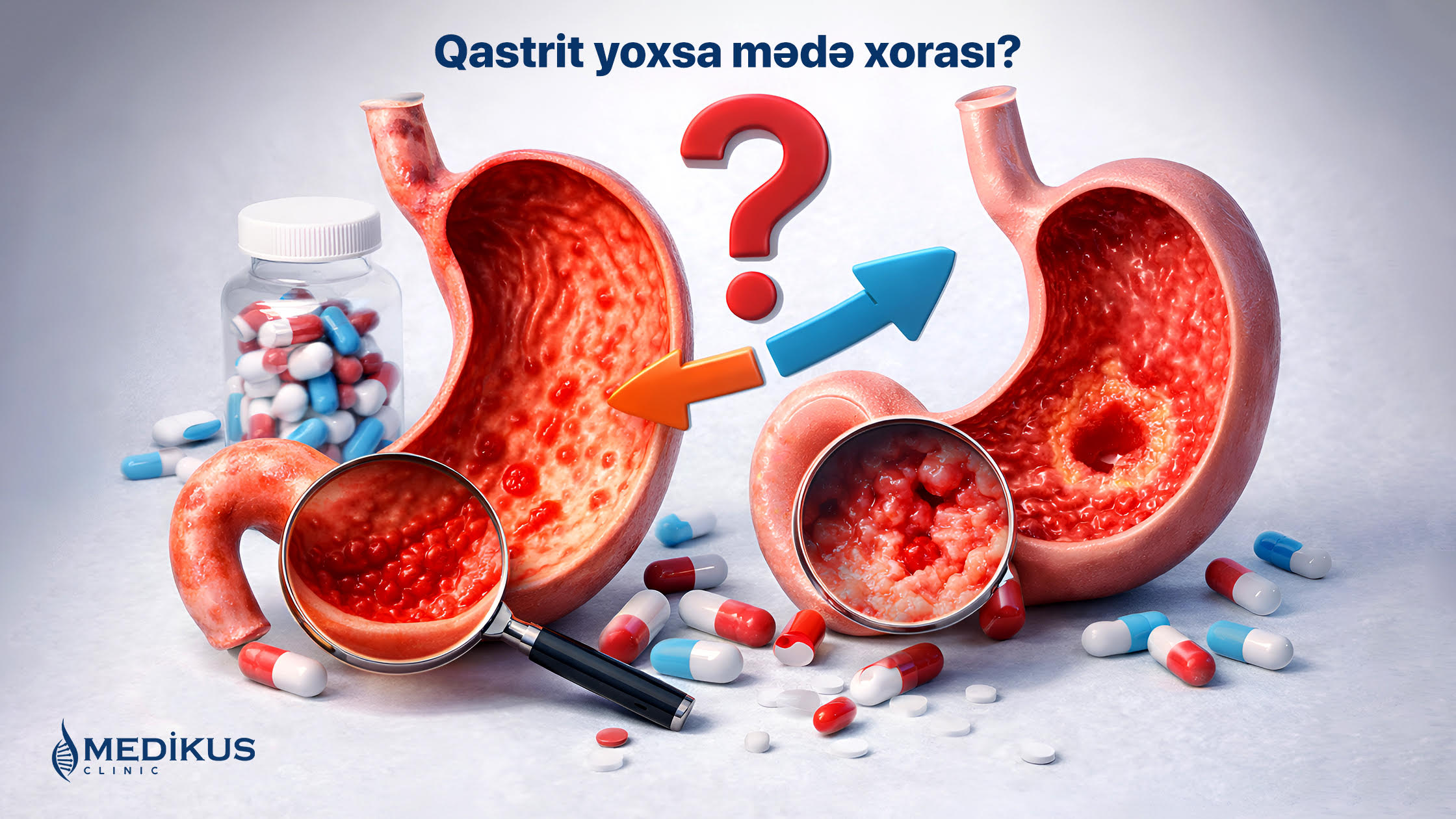 🩺 Qastrit, yoxsa Mədə Xorası? Simptomları necə ayırd etməli?